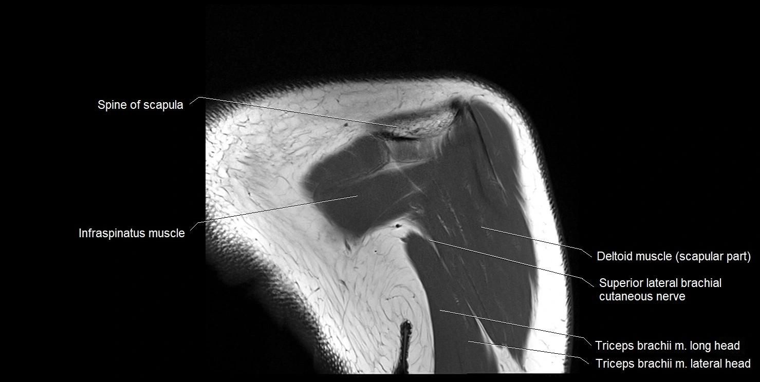 mri shoulder coronal cross sectional anatomy image 18.webp